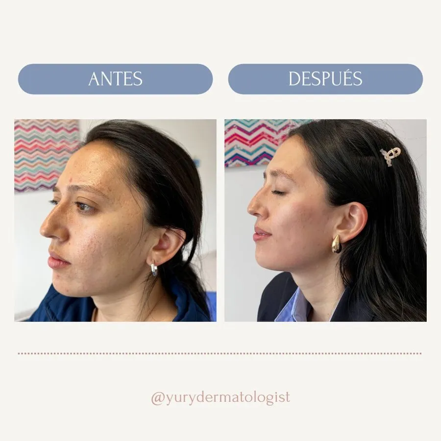 Before and after acne treatment