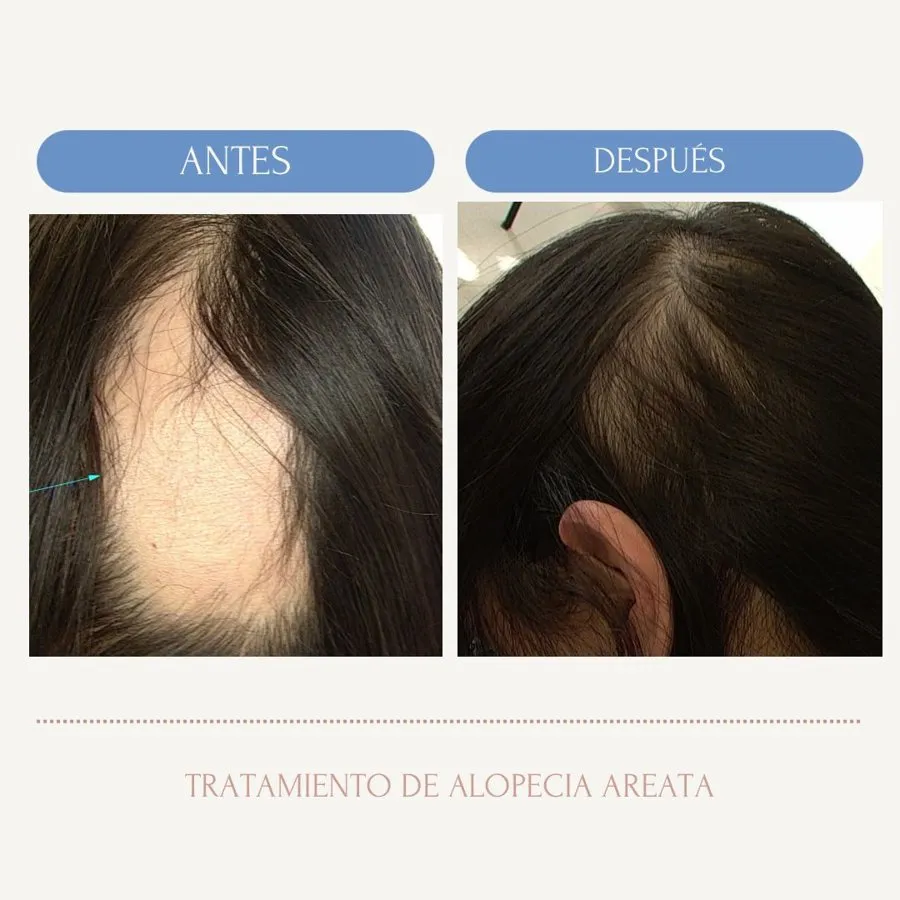 Before and after alopecia areata treatment