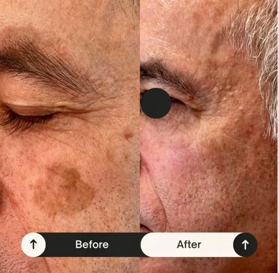 Before and after dark spot treatment